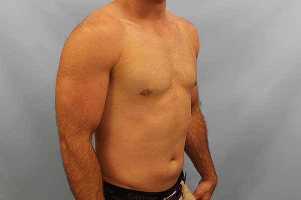 Gynecomastia Treatment NYC | Long Island | Male Breast Reduction NYC