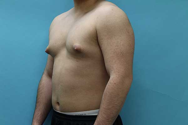Gynecomastia Surgery NYC | Long Island | Male Breast Reduction NYC