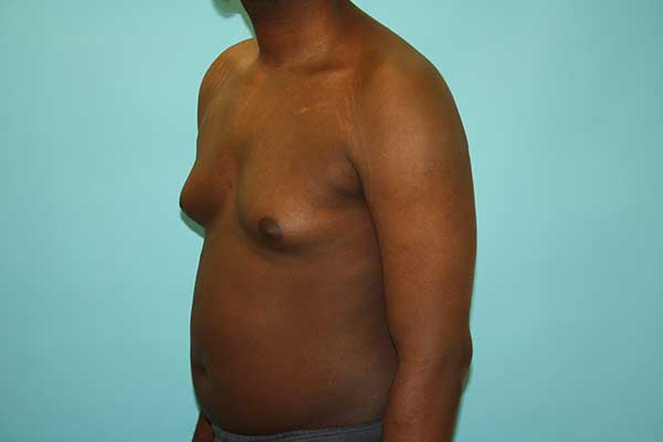 Male Breast Reduction NYC | Long Island | Gynecomastia Surgery Long Island