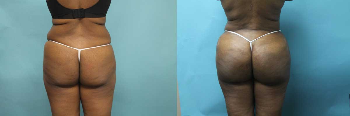 Brazilian Butt Lift NYC | Long Island | Butt Lift Surgery Long Island