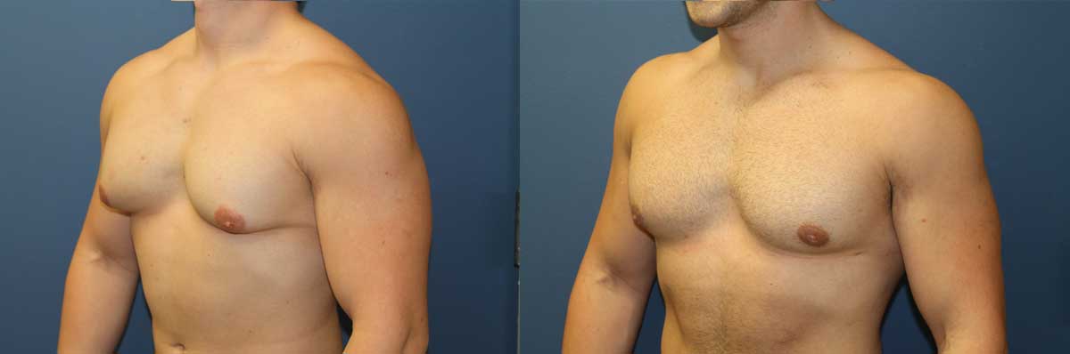 Gynecomastia Long Island | NYC | Male Breast Reduction Long Island