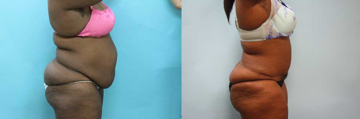 Tummy Tuck Surgery Long Island | Liposuction Surgery NYC | Wall Street Cosmetic Surgery